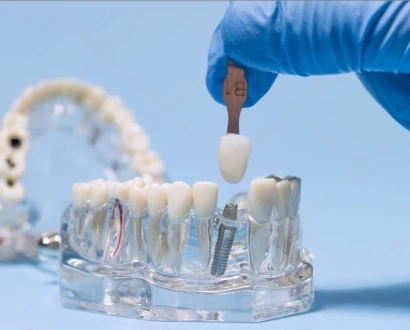 Имплантация